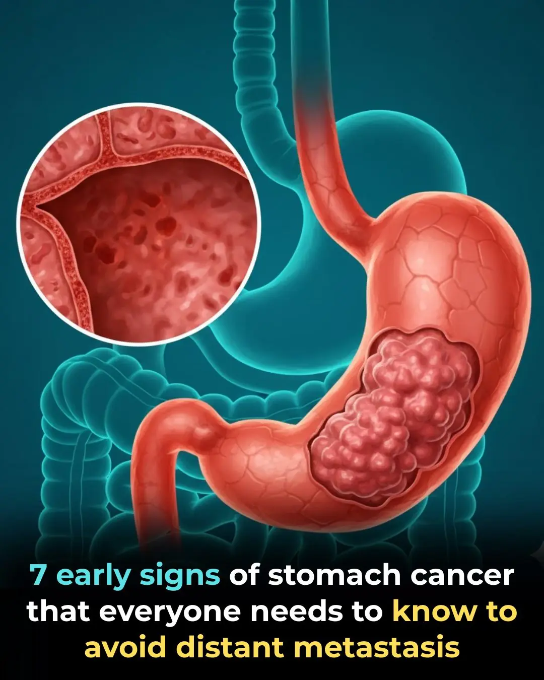 7 Early Warning Signs of Stomach Cancer Everyone Should Know Before It Spreads