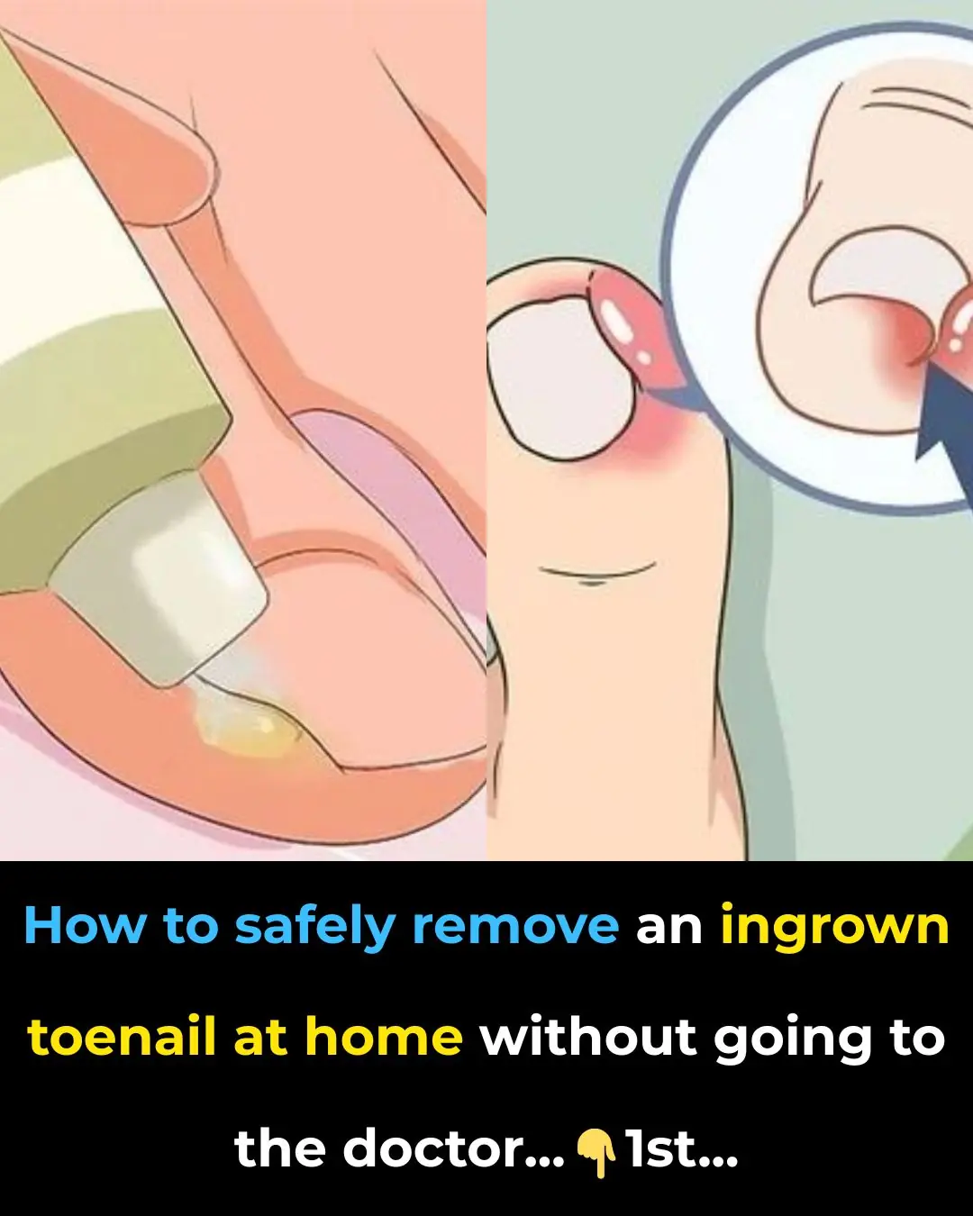 How to Effectively Remove a Painful Ingrown Toenail WITHOUT Having To Go To The Doctor