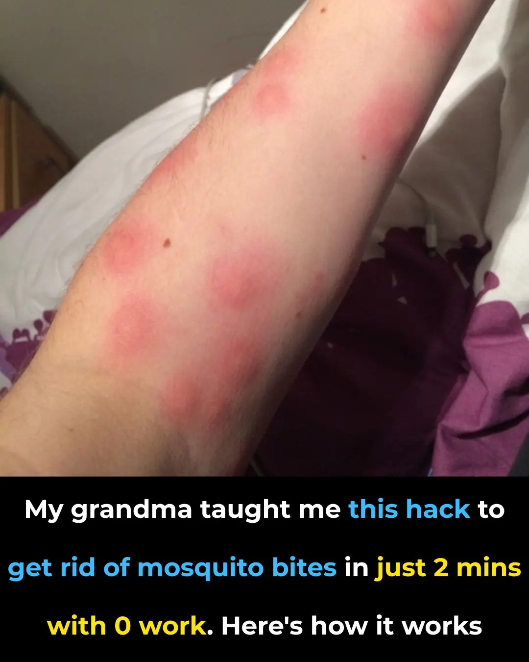 The Hot Spoon Hack for Mosquito Bites