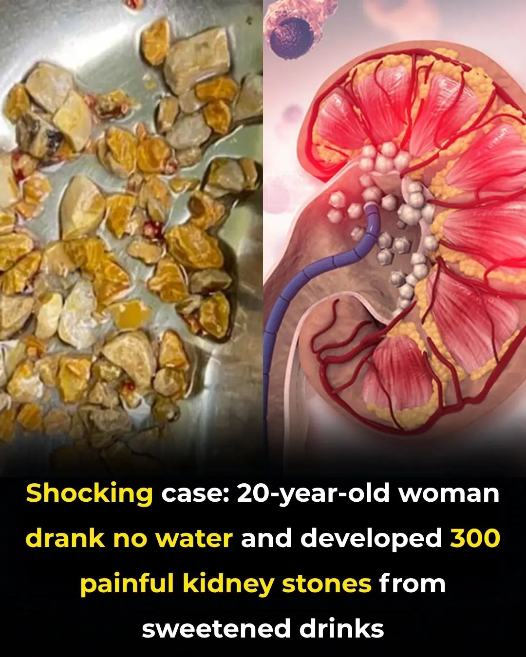 More Than 300 Kidney Stones: A Startling Warning About Sugary Drinks and Dehydration