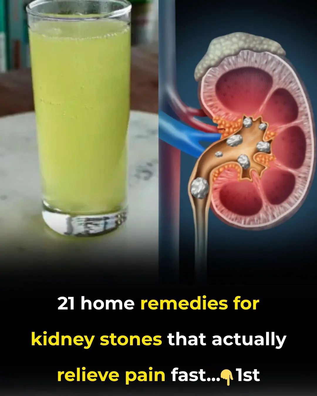 Home Remedies For Kidney Stones – 21 Remedies For Effective Pain Relief