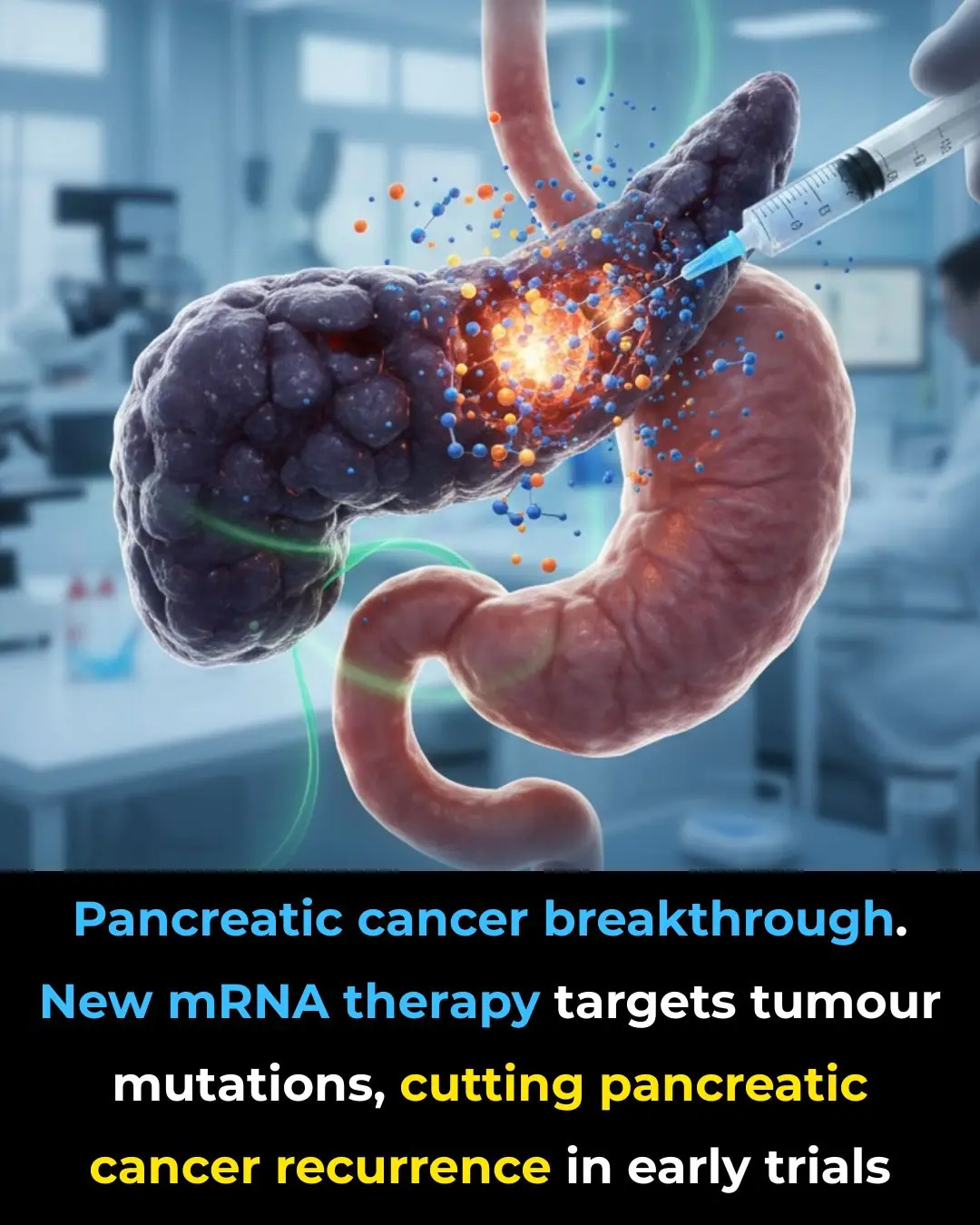 Revolutionary mRNA Therapy Shows Promise in Preventing Pancreatic Cancer Recurrence