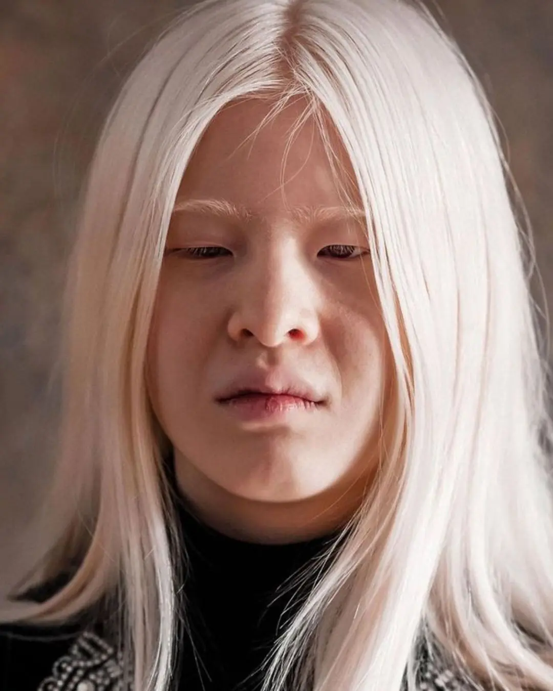 Girl Abandoned By Parents For Her Looks Wants To Prove The World Wrong โ Now She Models For Vogue