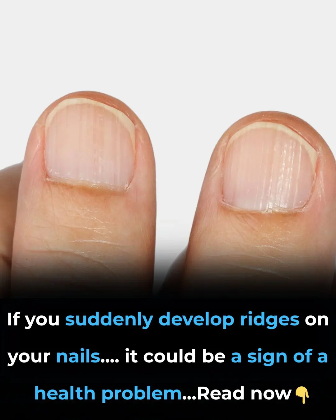 If You’ve Noticed Ridges in Your Fingernails, This Is What It Really Means