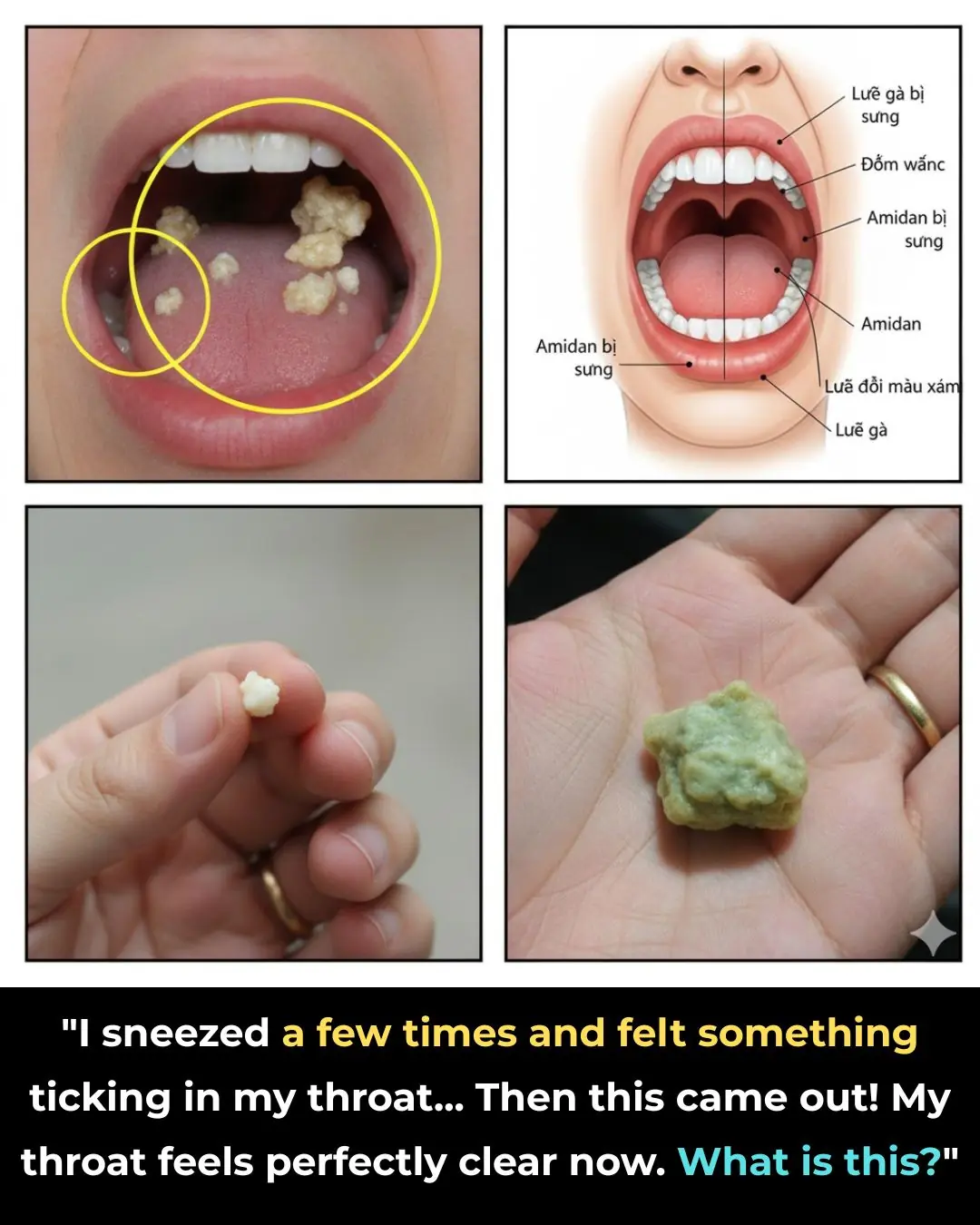 What Are Tonsil Stones