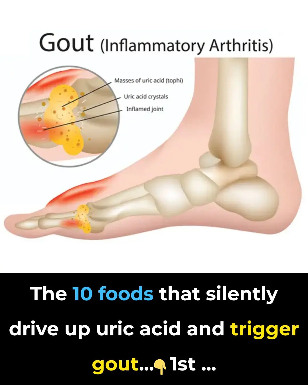 Top 10 Uric Acid Foods To Avoid If You Have Gout