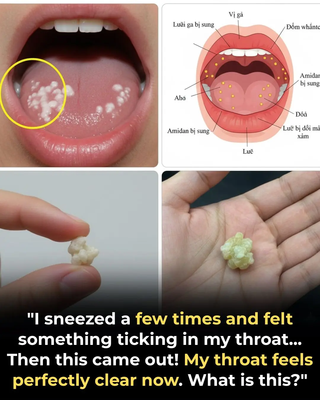 What Are Tonsil Stones