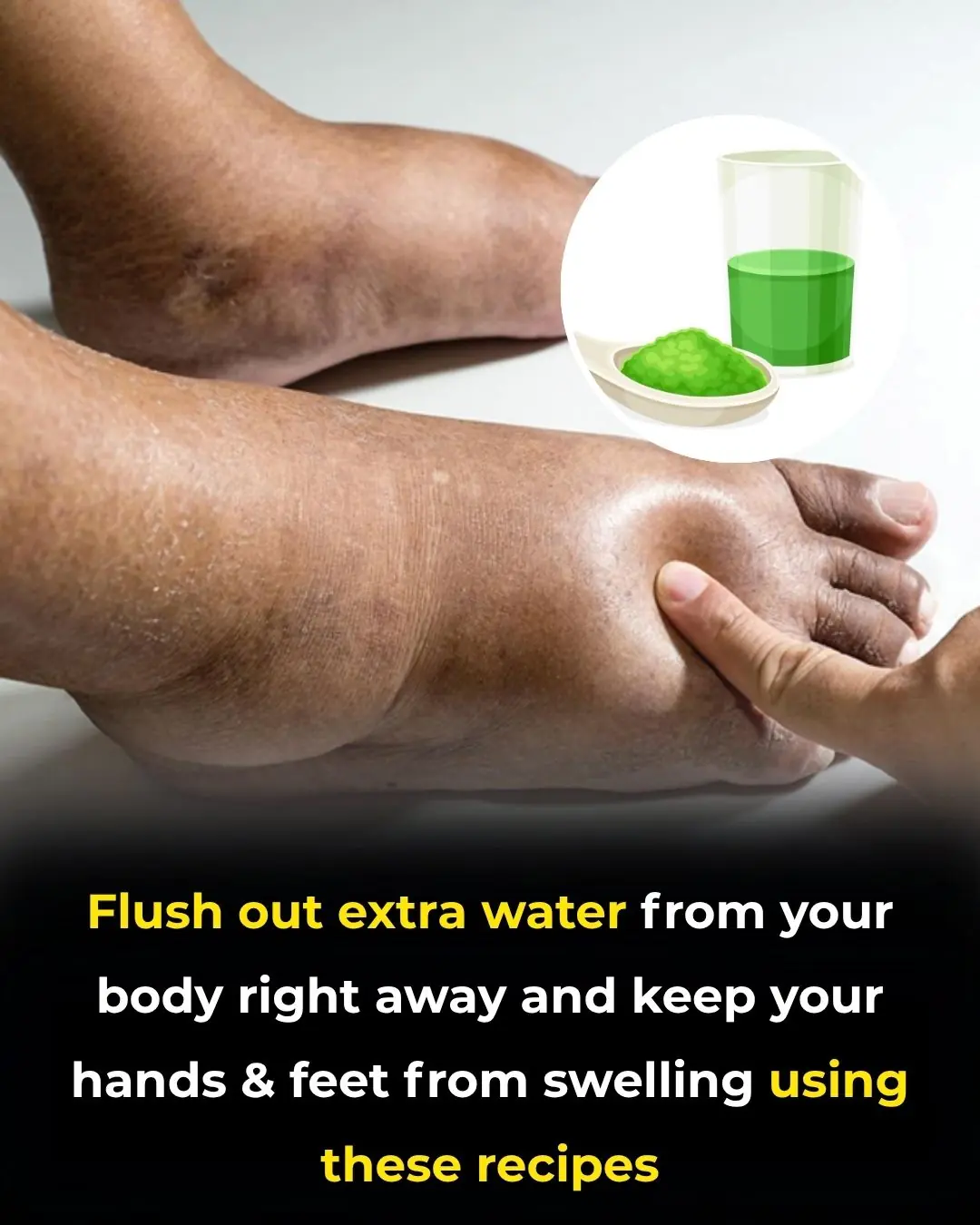 Say Goodbye to Swelling: Natural Ways to Beat Water Retention Fast!