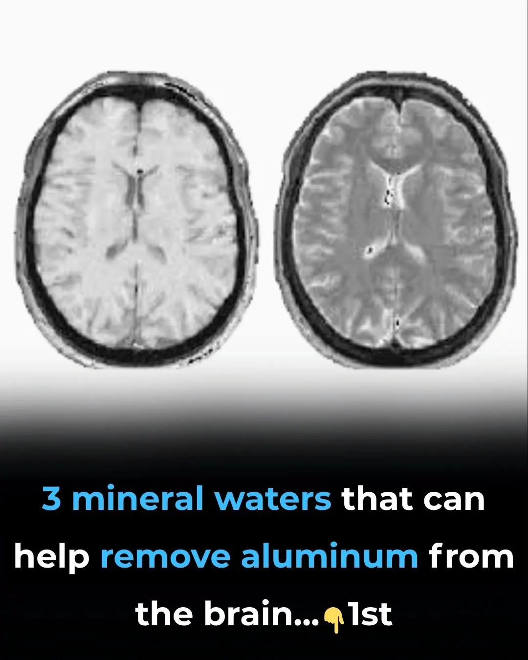 3 Mineral Waters That Can Help Remove Aluminum From The Brain