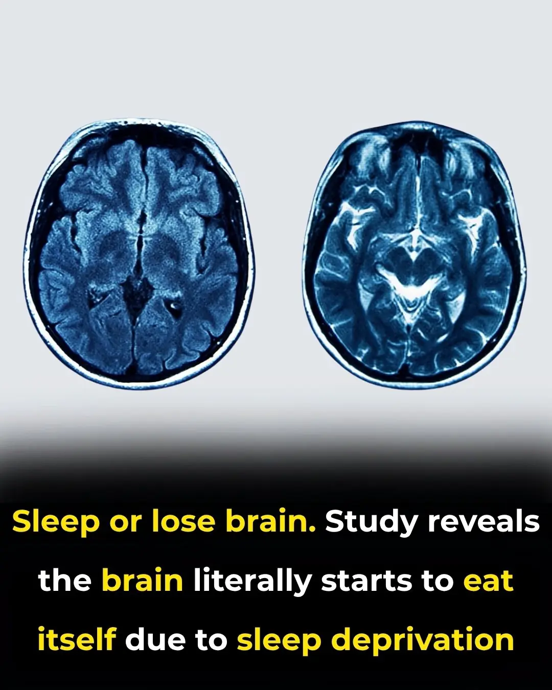 When the Brain Begins to Consume Itself: The Hidden Costs of Chronic Sleep Loss