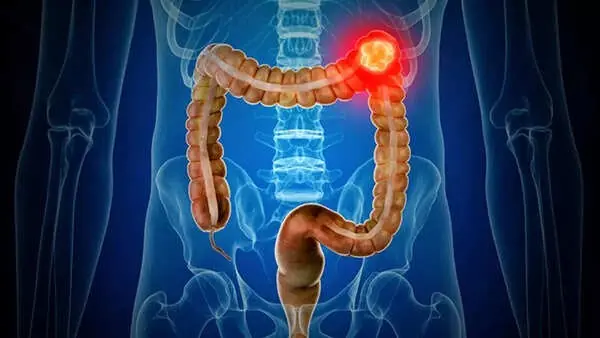 Everyday symptoms that keep appearing in people with bowel cancer
