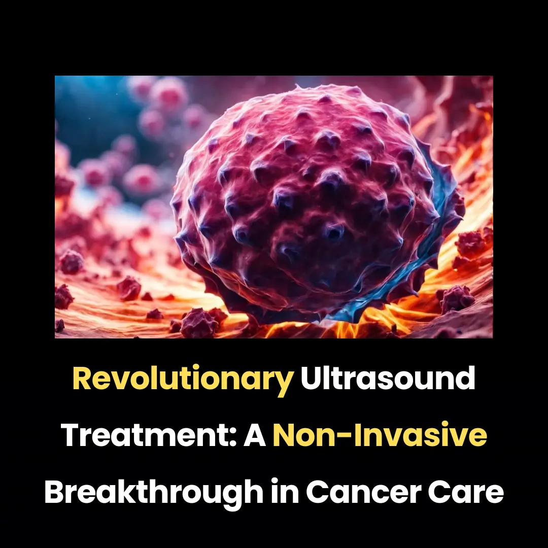 Revolutionary Ultrasound Treatment: A Non-Invasive Breakthrough in Cancer Care