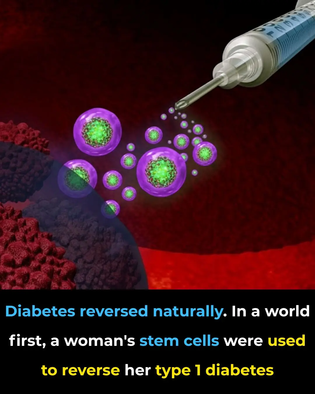 World-First Breakthrough: Stem Cells Reverse Type 1 Diabetes in Landmark Case
