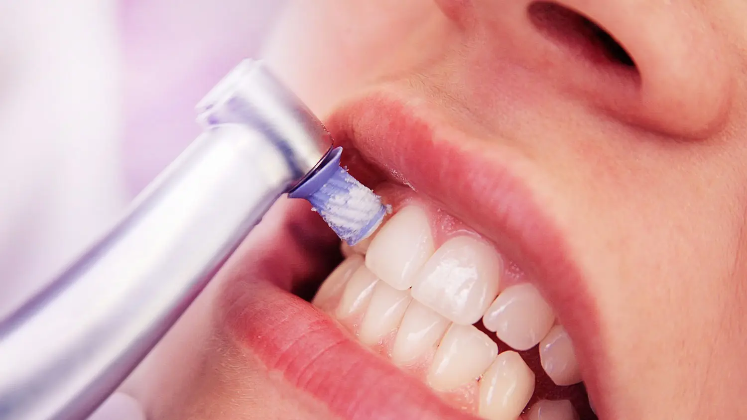 7 hacks to remove tartar stains effortlessly