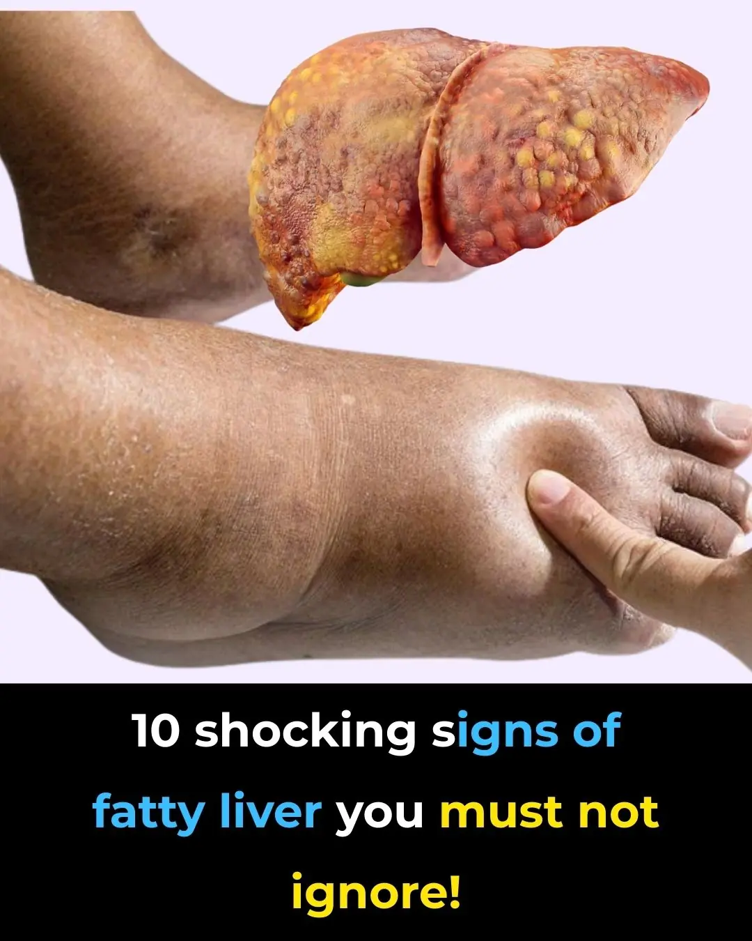 10 shocking signs of fatty liver you must not ignore!
