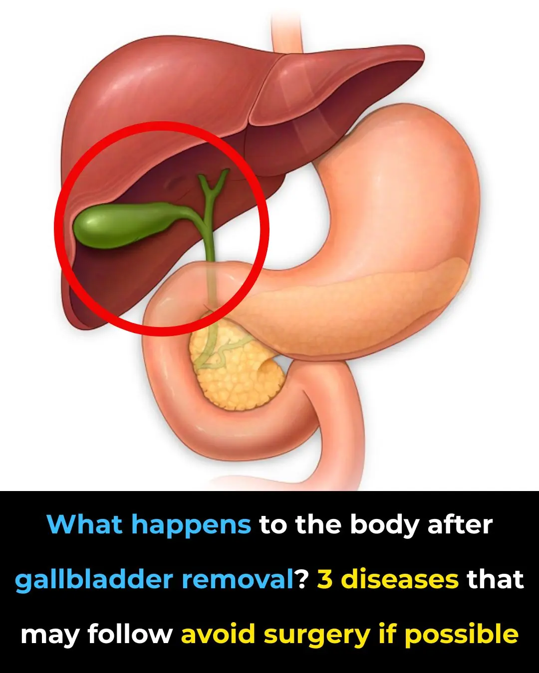 Gallbladder removal: what happens next and 3 risks to watch for