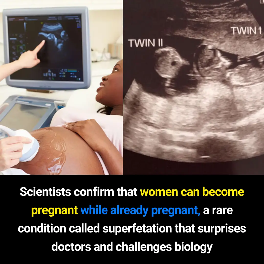 Superfetation: The Rare Phenomenon of Becoming Pregnant While Already Pregnant