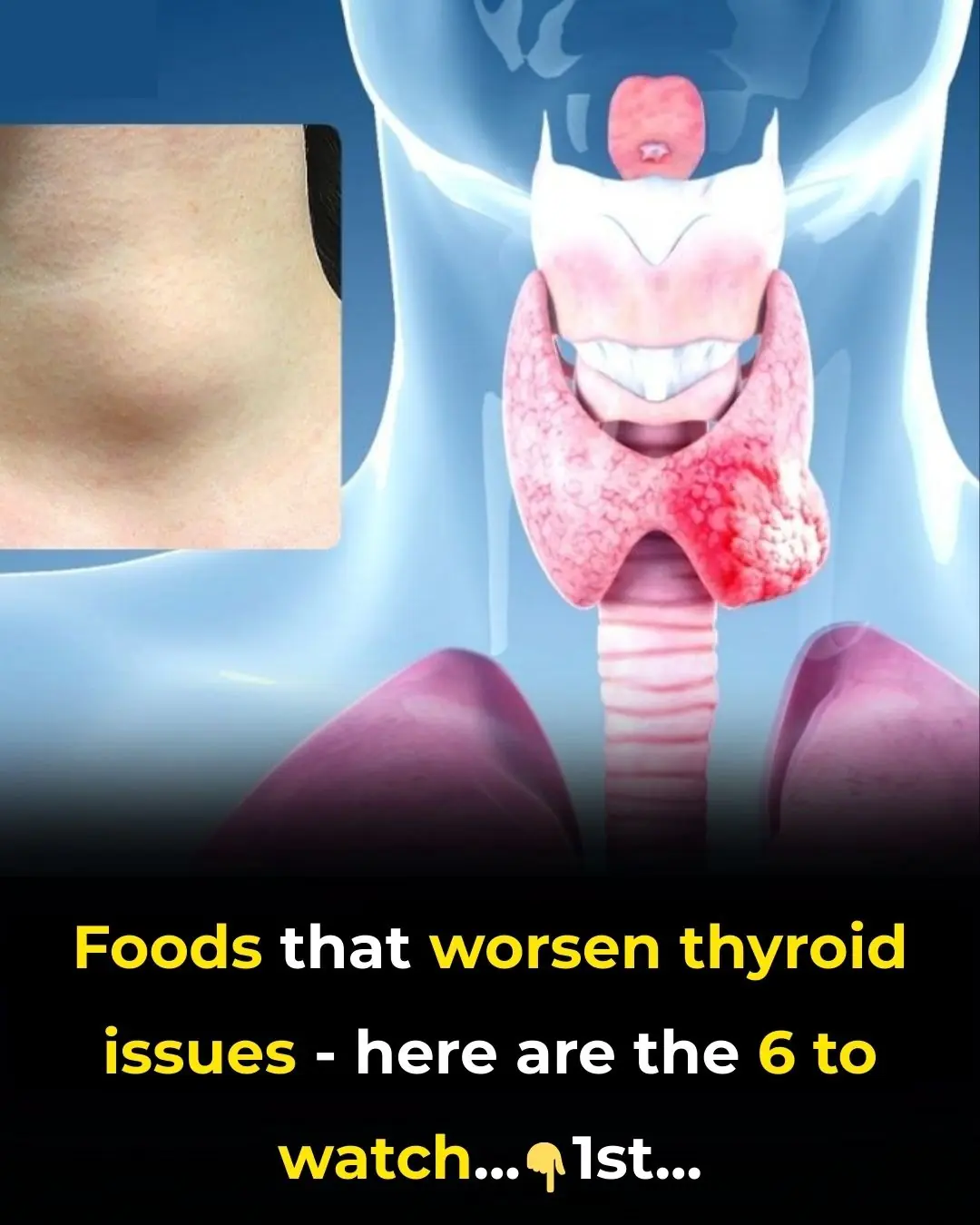 6 Foods You Absolutely Need To Avoid If You Suffer From a Thyroid Disorder