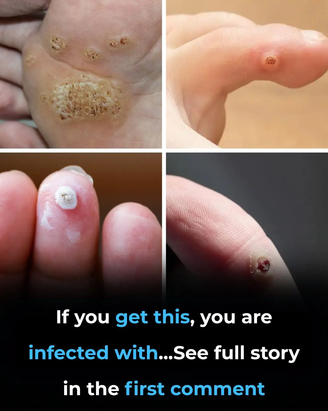 6 Types of Warts (Signs, Symptoms, Home Remedies, and Treatment)