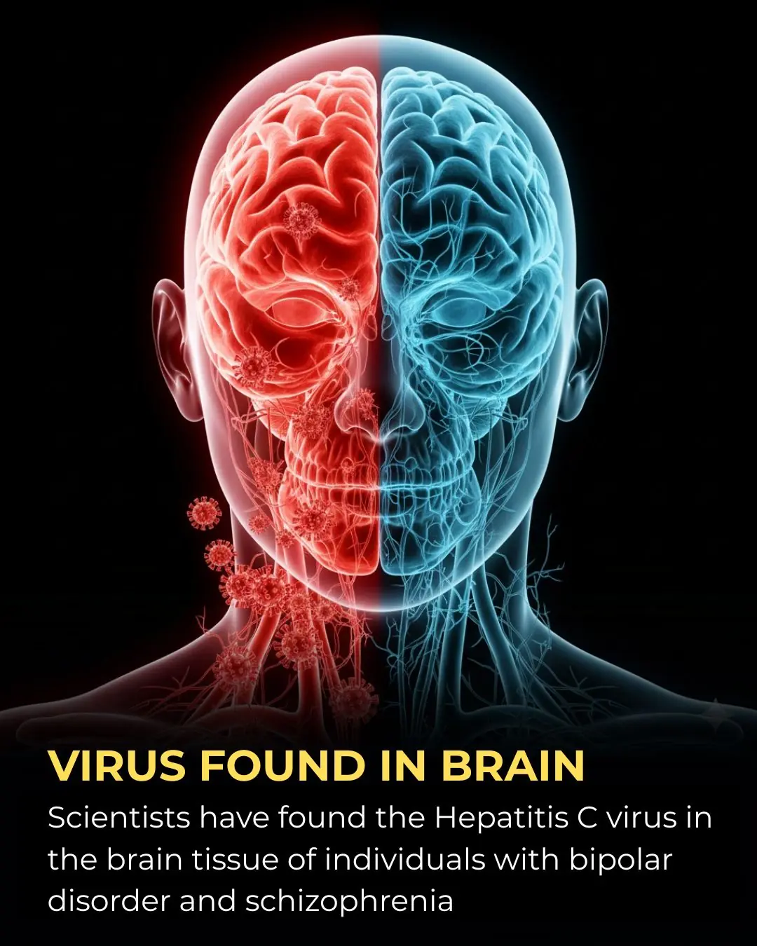 Hepatitis C Virus Detected in Brain Tissue: A Potential Link to Schizophrenia and Bipolar Disorder