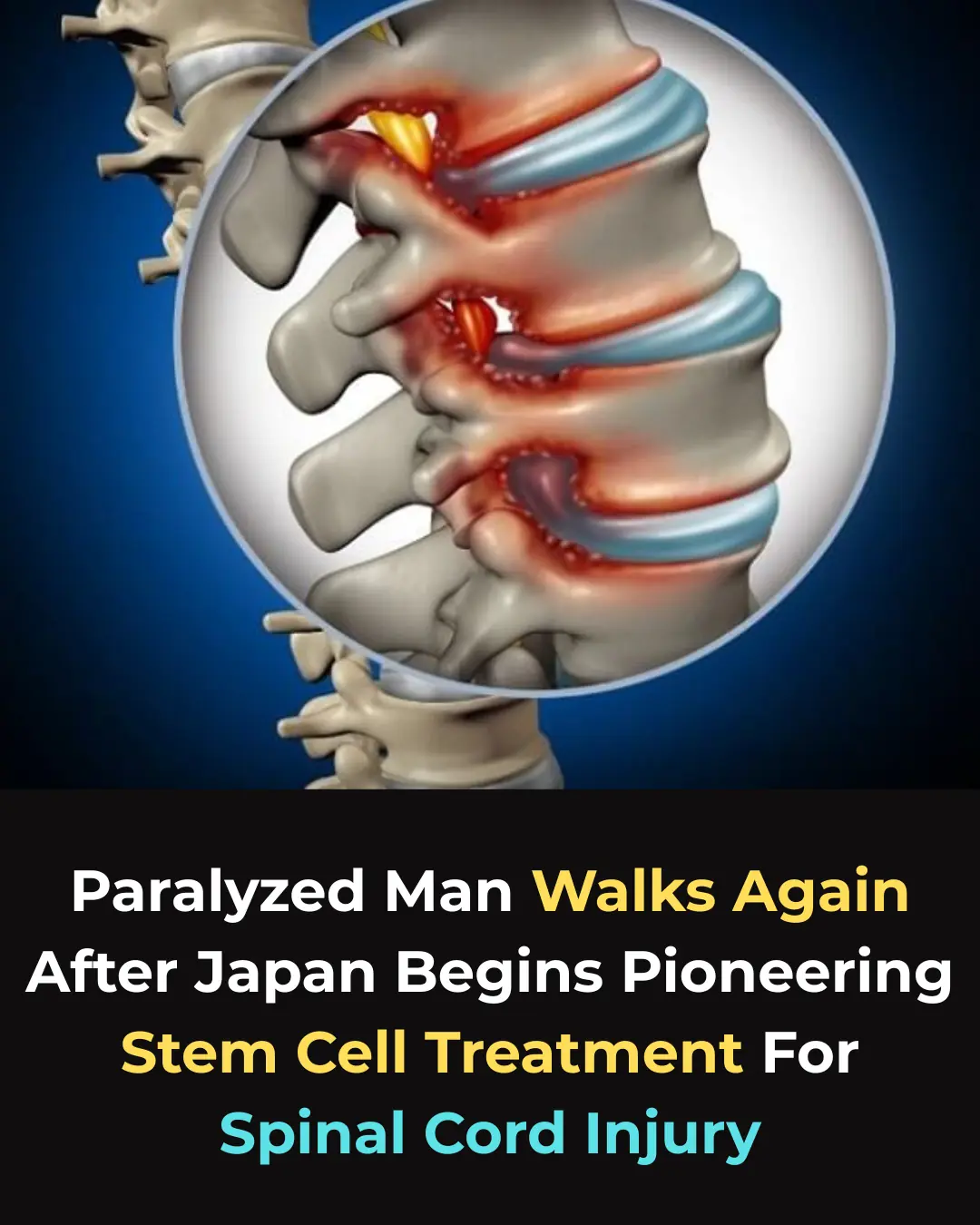 Regenerative Medicine Milestone: Stem-Cell Trial Restores Motor Function in Paralyzed Patients