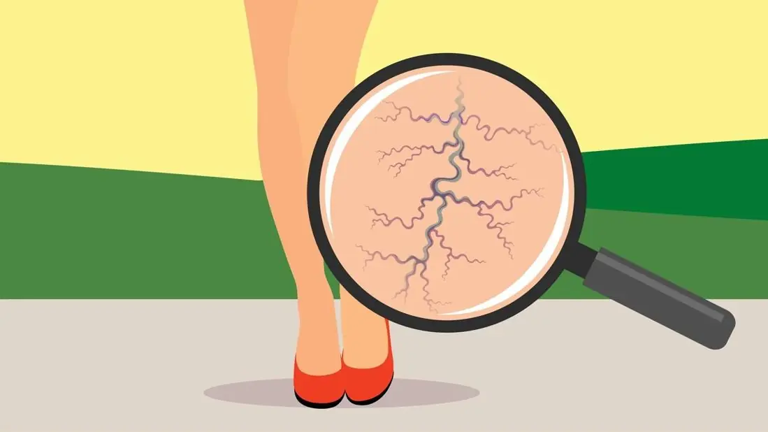 The Best Natural Remedies to Treat and Prevent Varicose Veins Effectively