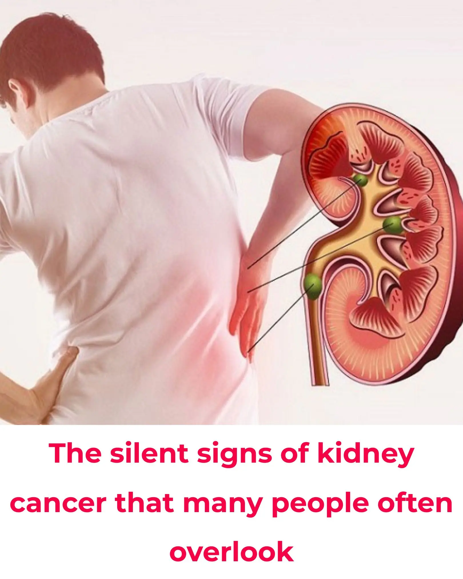 Subtle Signs of Kidney Cancer That Are Easily Overlooked