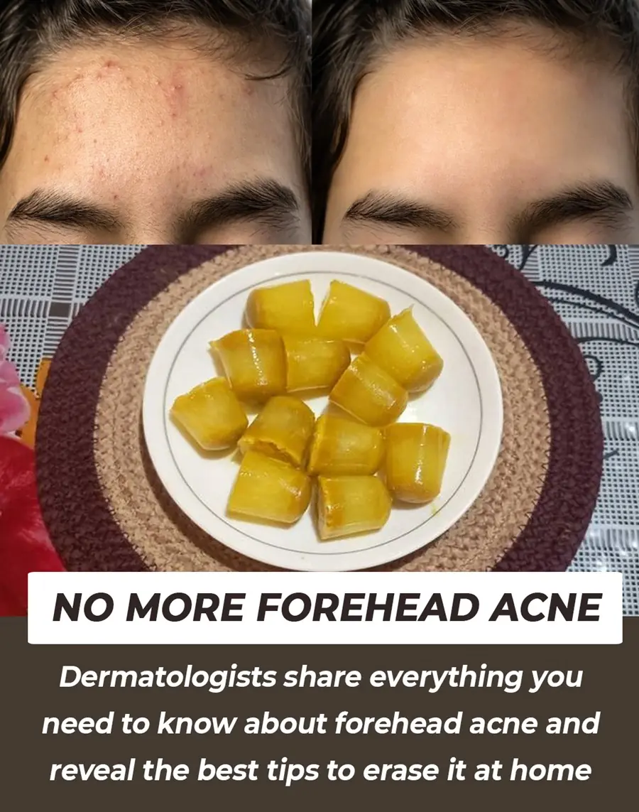 Forehead Acne and What to Do About It