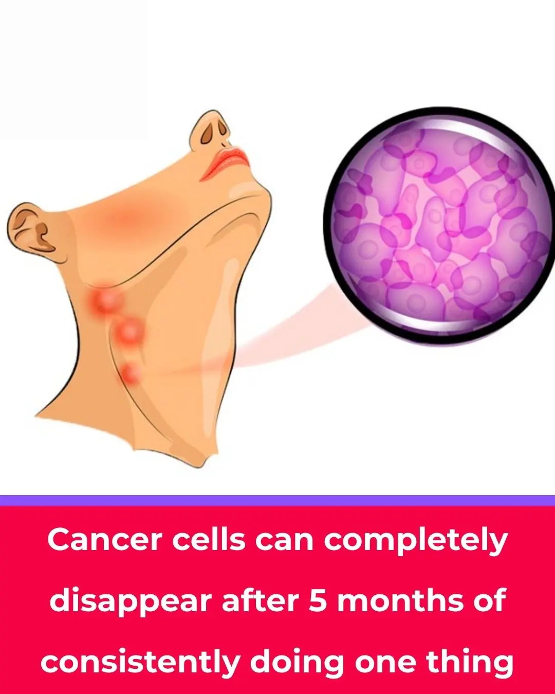 Cancer cells disappeared after 5 months thanks to consistent medical treatment