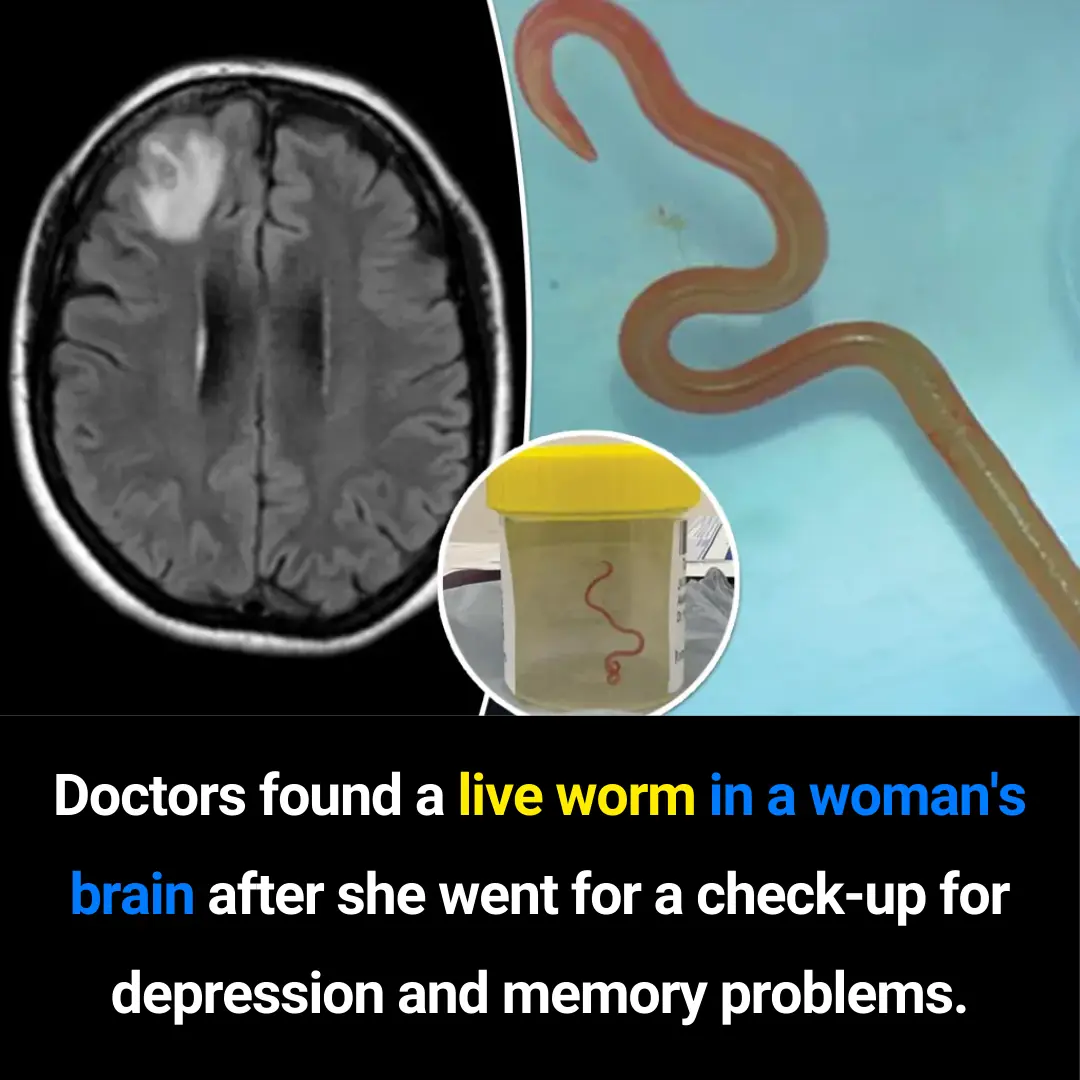 Doctors Discover First-Ever Live Worm Found in a Human Brain: A Historic Medical Case in Australia