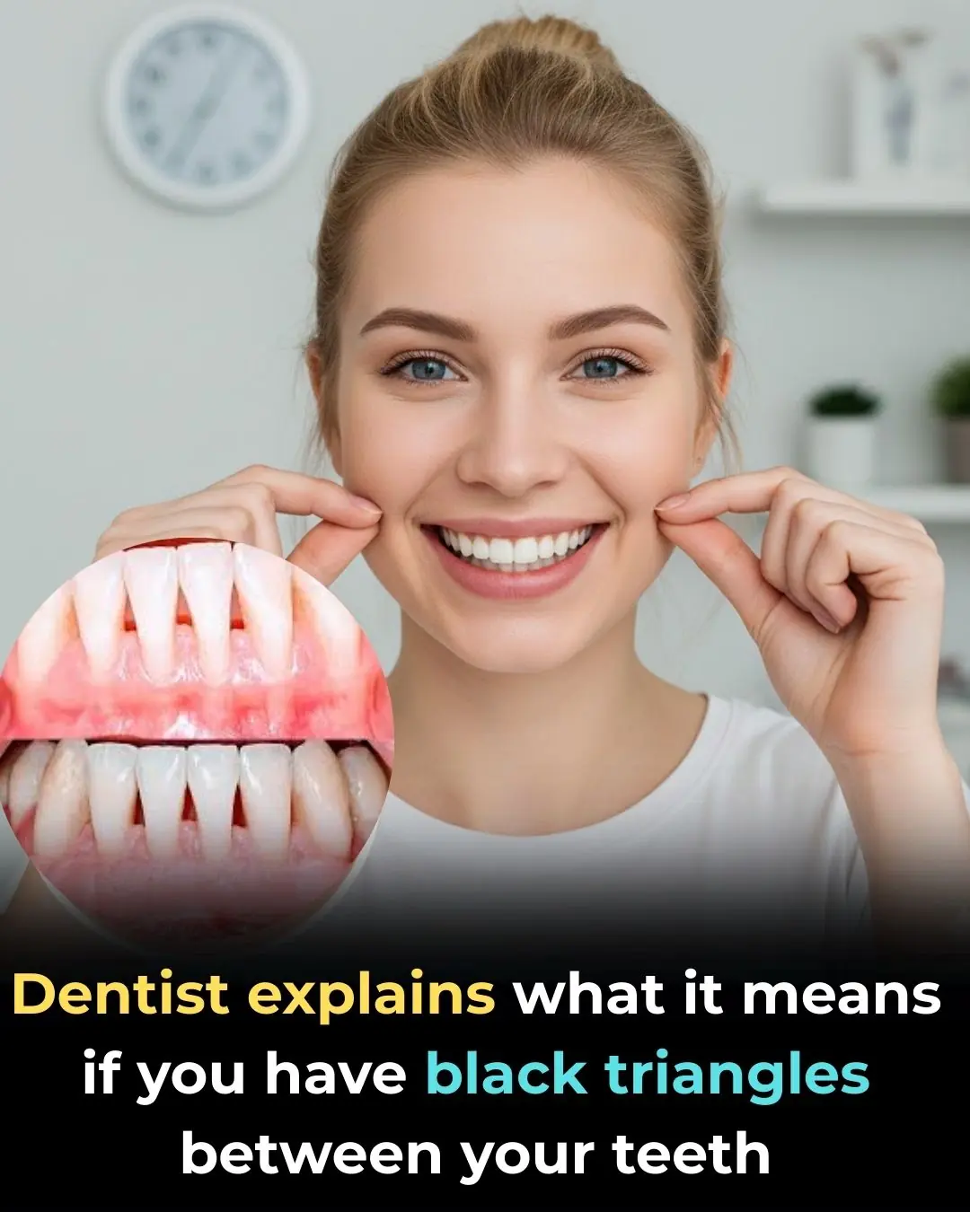 What Are the “Black Triangles” Between Your Teeth
