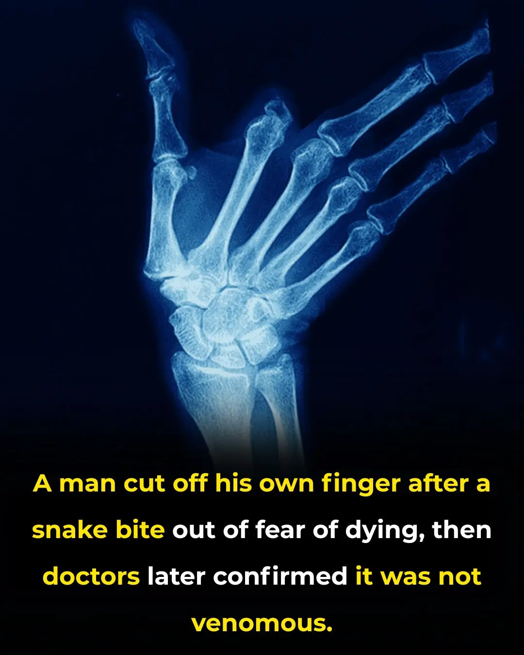 Snakebite Panic Leads Farmer to Sever Finger, Doctors Confirm No Danger