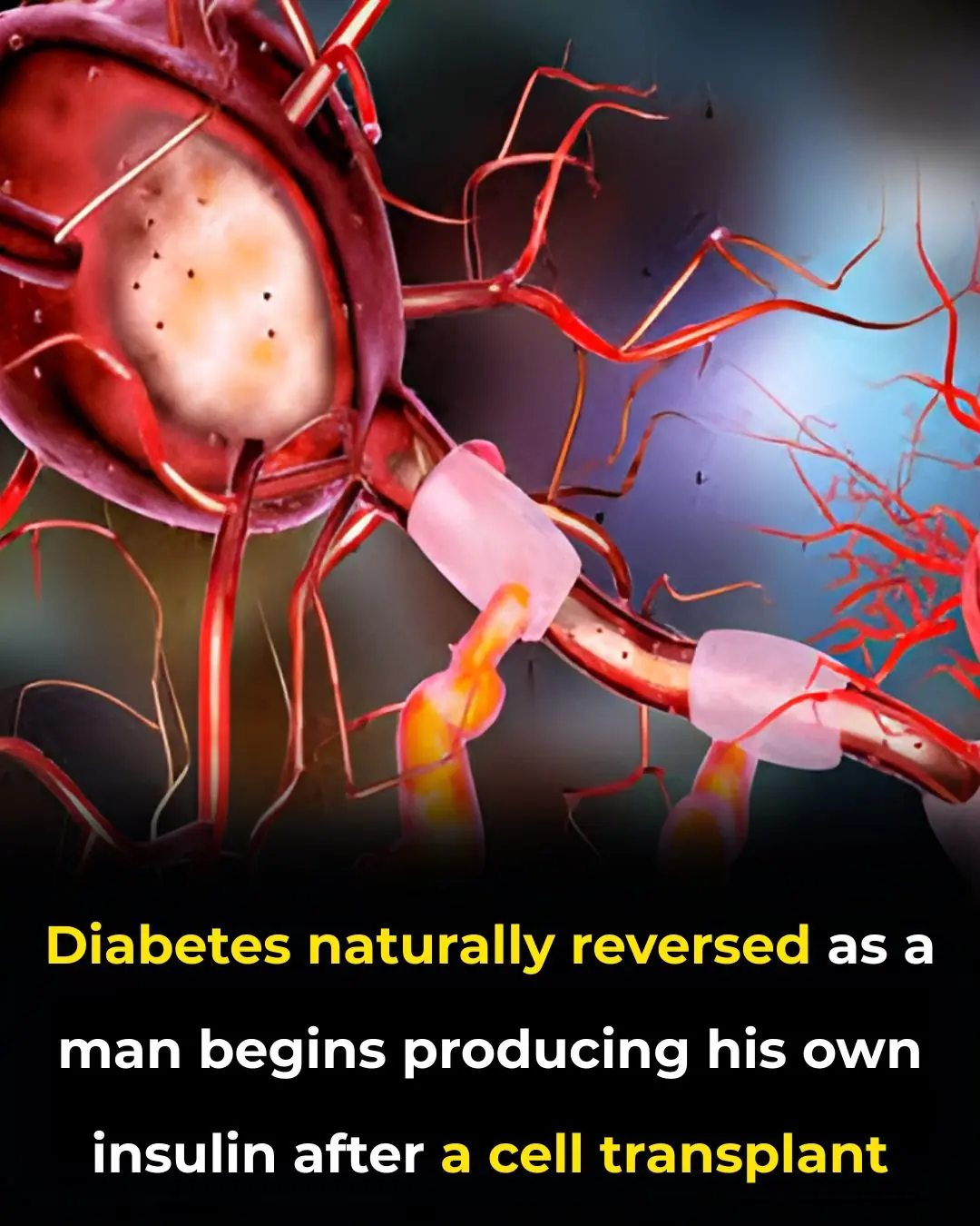 Breakthrough Cell Transplant Restores Insulin Production, Offering New Hope for Diabetes Reversal