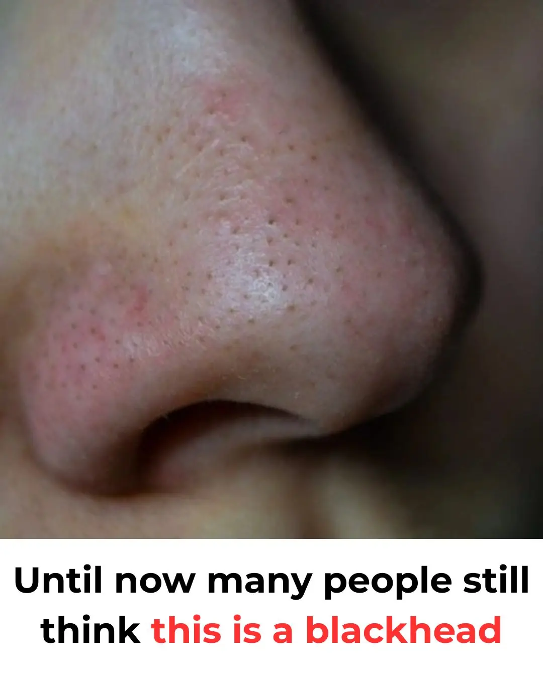Why Those Tiny Dots on Your Nose Are Completely Normal