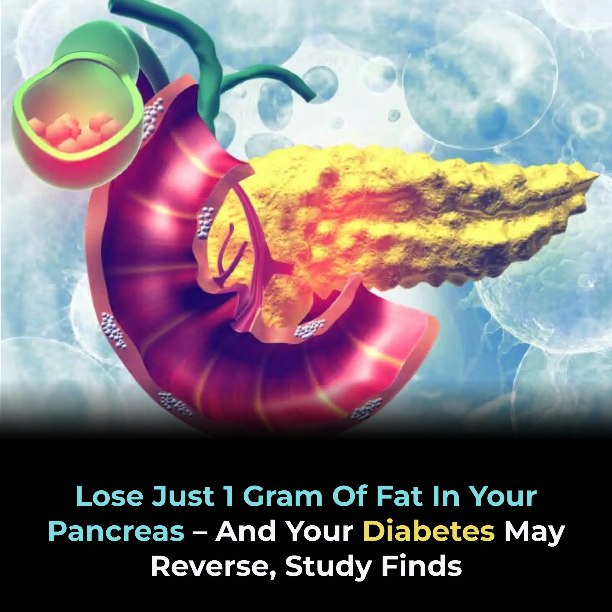 Lose just 1 gram of fat in your pancreas – and your diabetes may reverse, study finds