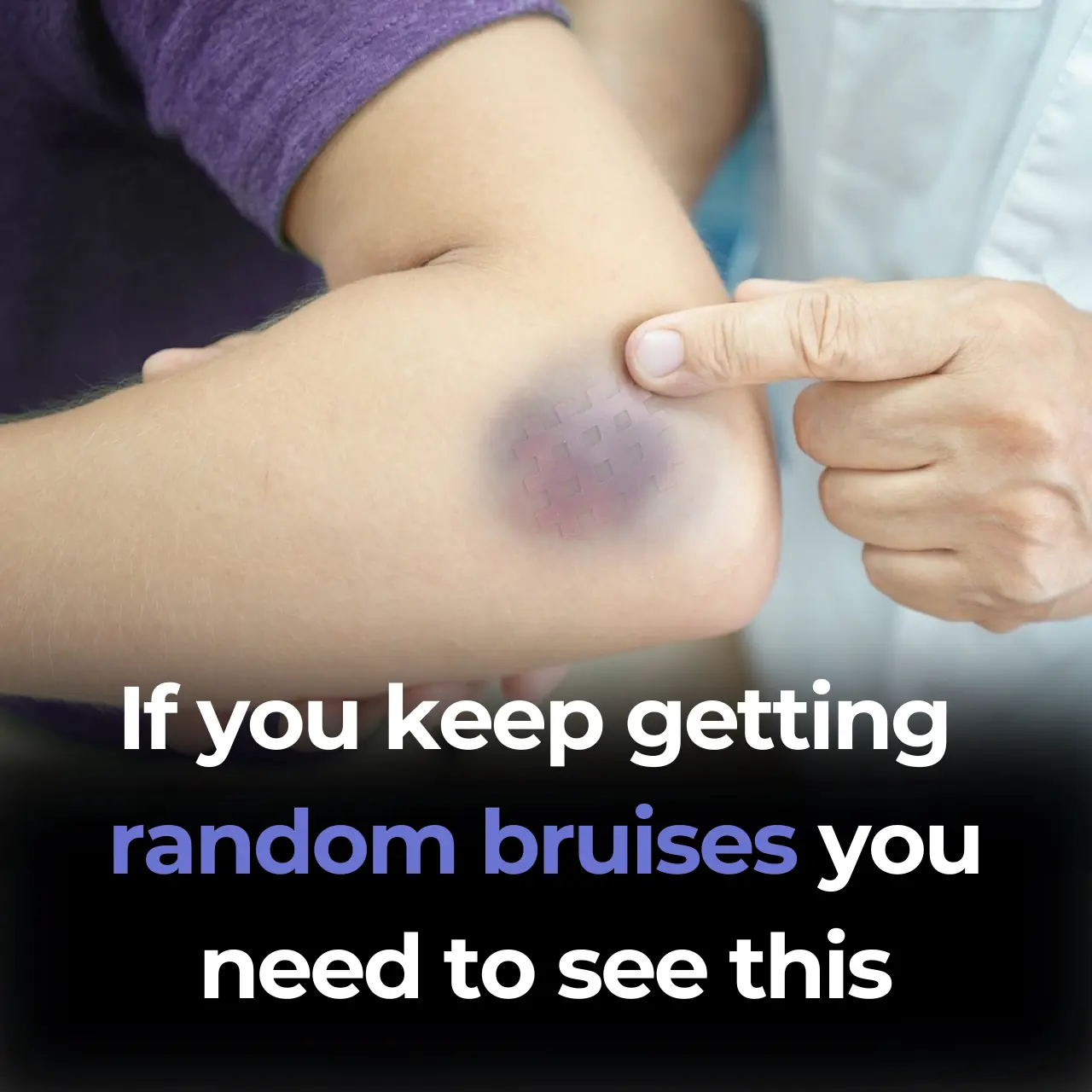 Unexplained Bruising on Your Body: Causes and Treatments