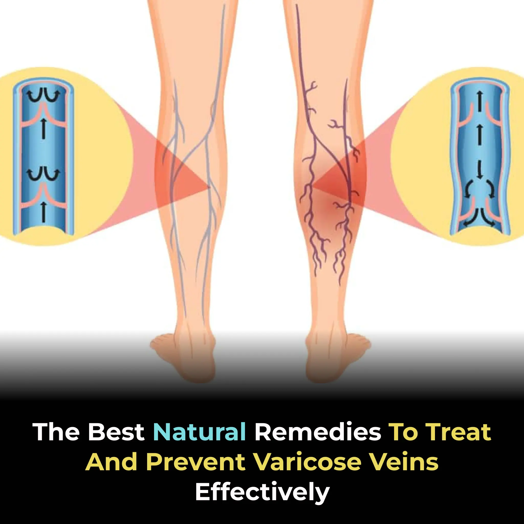 The Best Natural Remedies to Treat and Prevent Varicose Veins Effectively
