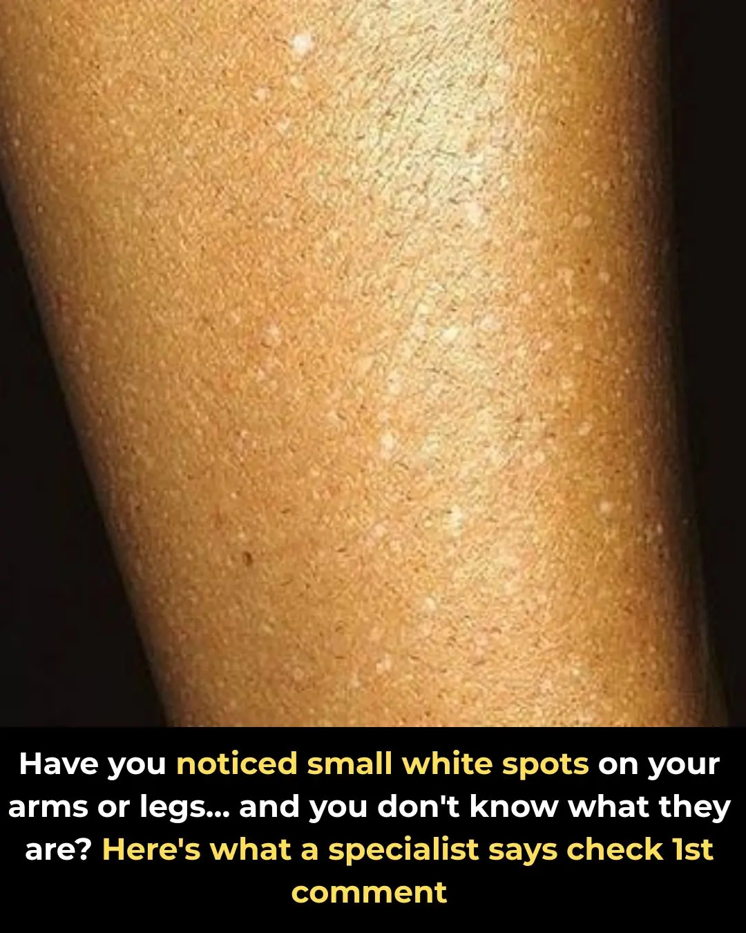 Have you noticed small white spots on your arms or legs… and you don't know what they are?