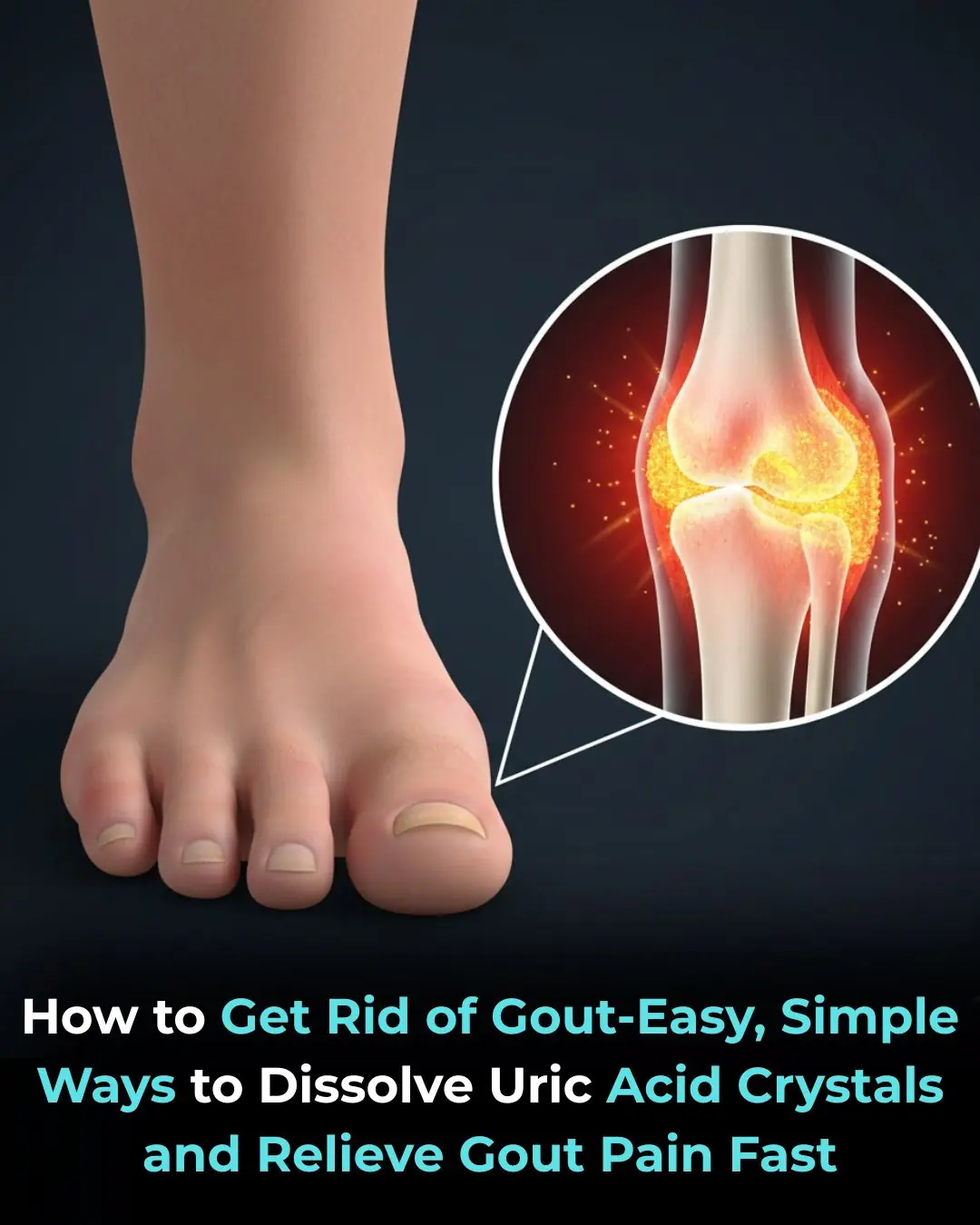 The Best Natural Gout Treatments: Remove Uric Acid Crystallization To Prevent Gout And Joint Pain