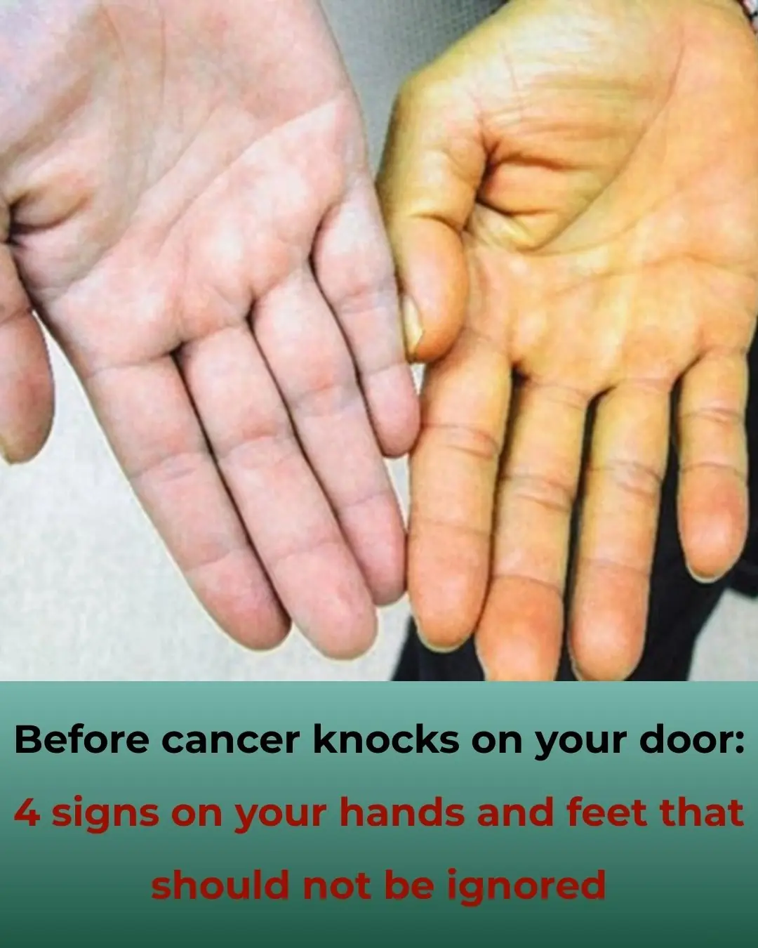 4 Warning Signs on Hands and Feet You Should Not Ignore Before Cancer Strikes