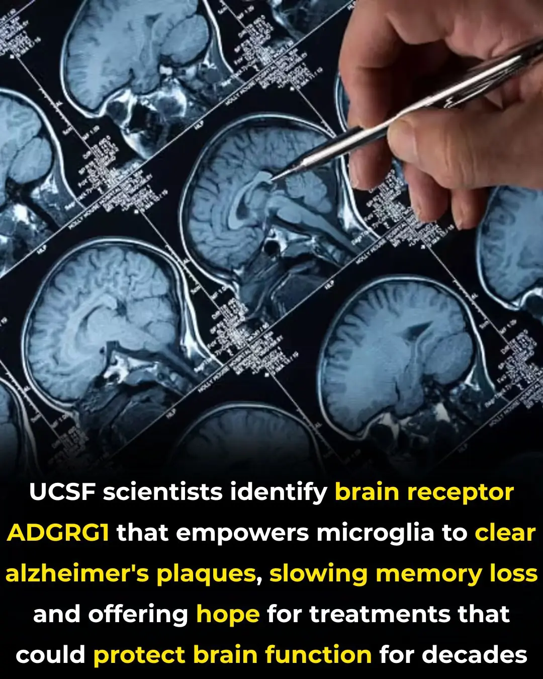 Scientists Discover a Brain Receptor That Acts as a Natural Shield Against Alzheimer’s