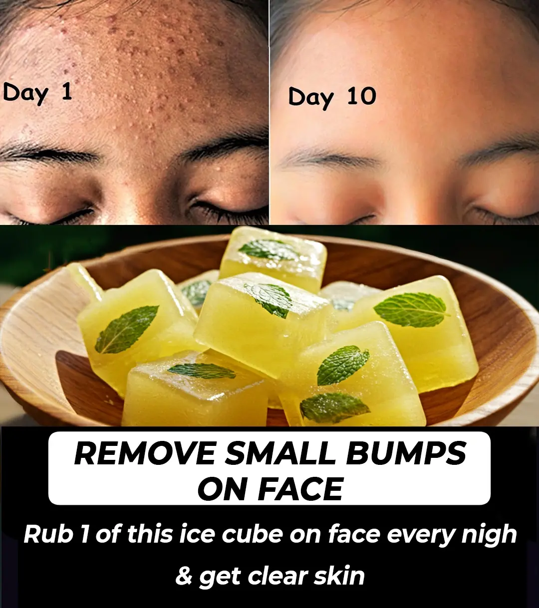 How to get rid of Small Bumps on Face & Forehead – Pimples and Fungal Acne
