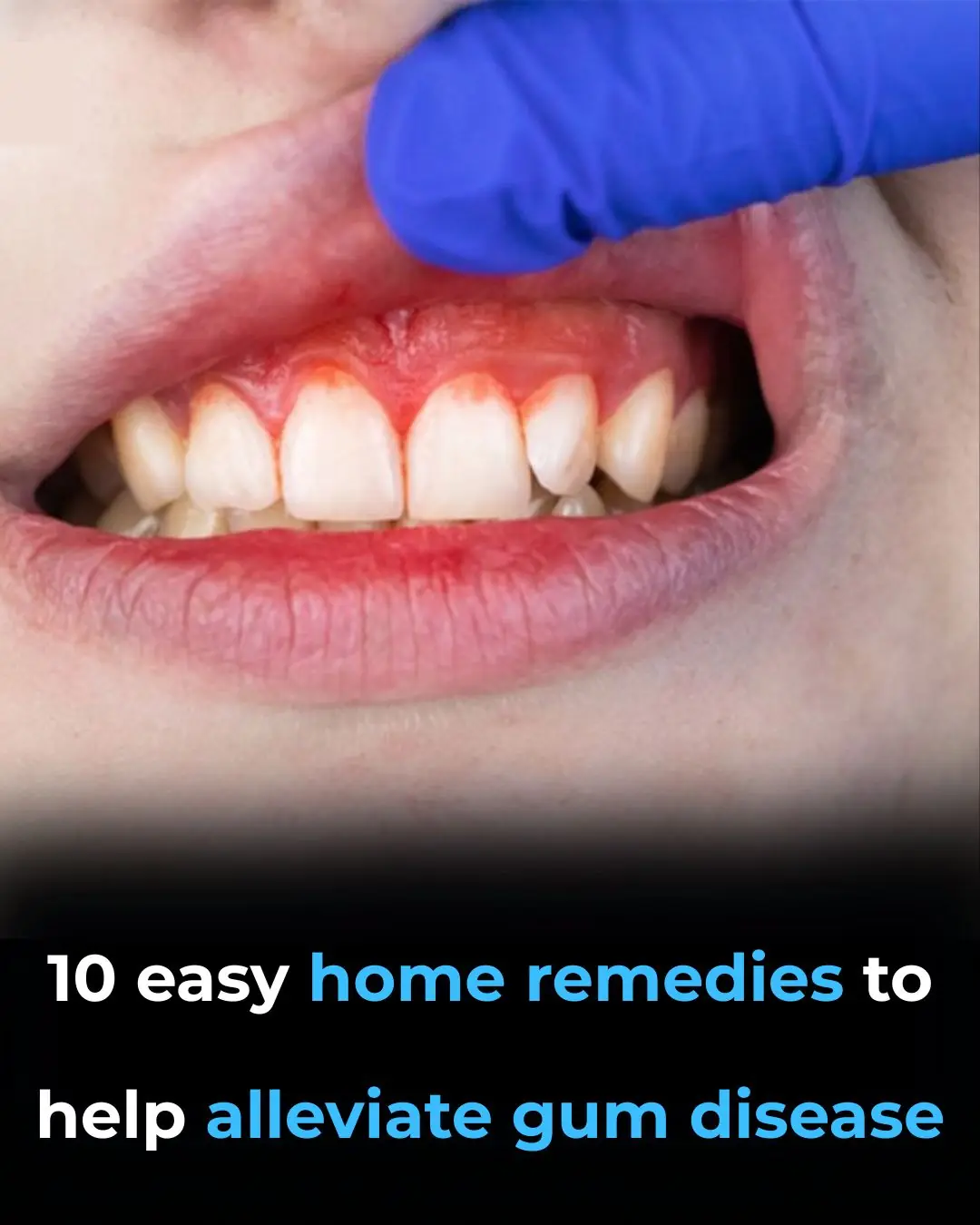 10 Easy Home Remedies to Help Alleviate Gum Disease