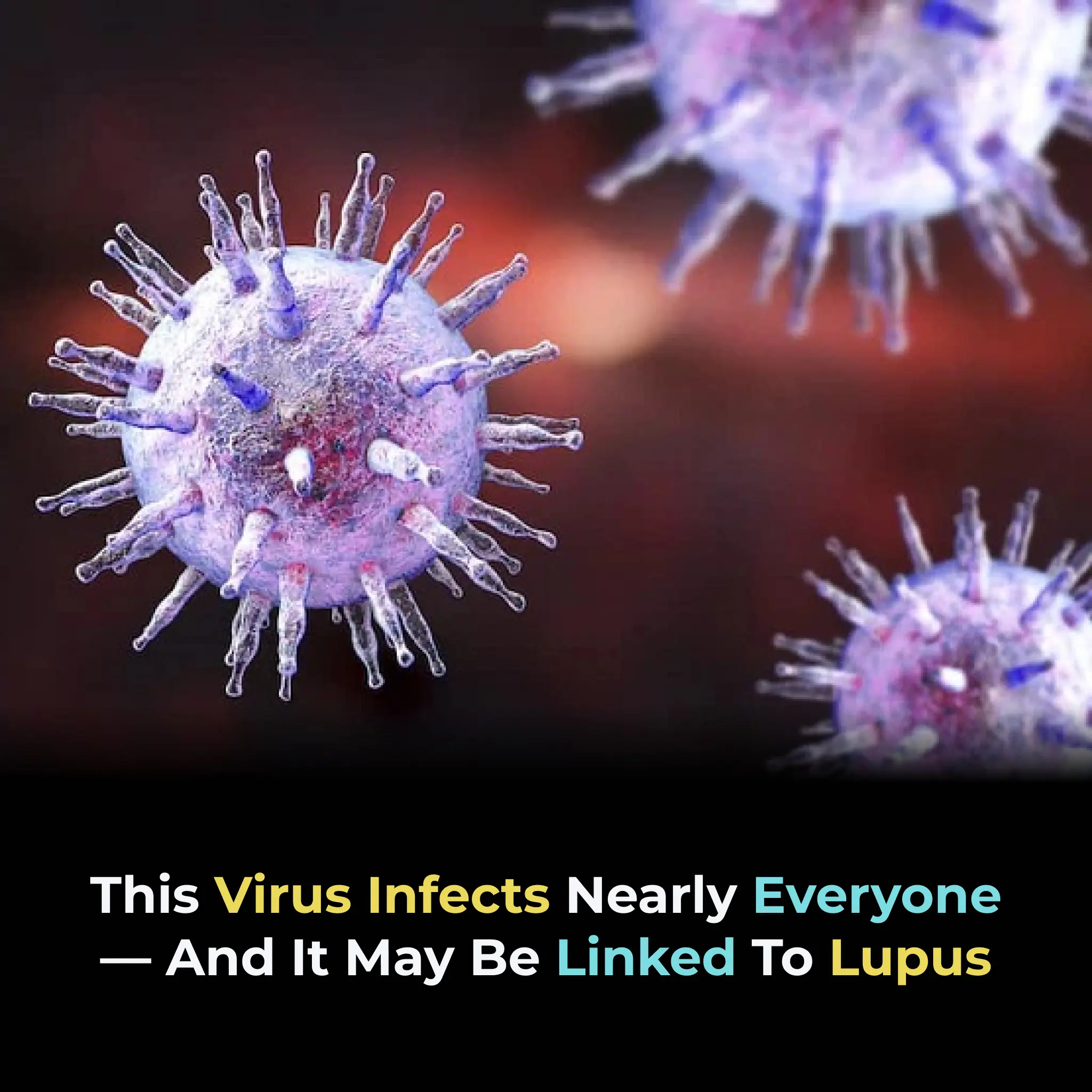 Epstein-Barr Virus Identified as Key Trigger for Lupus in Groundbreaking Study