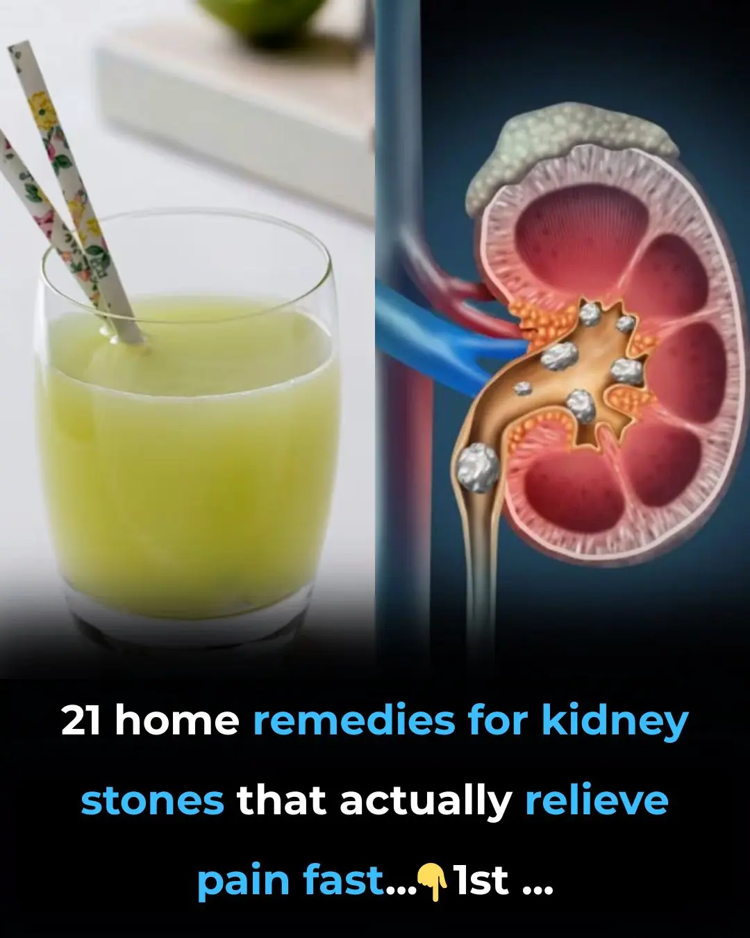 Home Remedies For Kidney Stones – 21 Remedies For Effective Pain Relief
