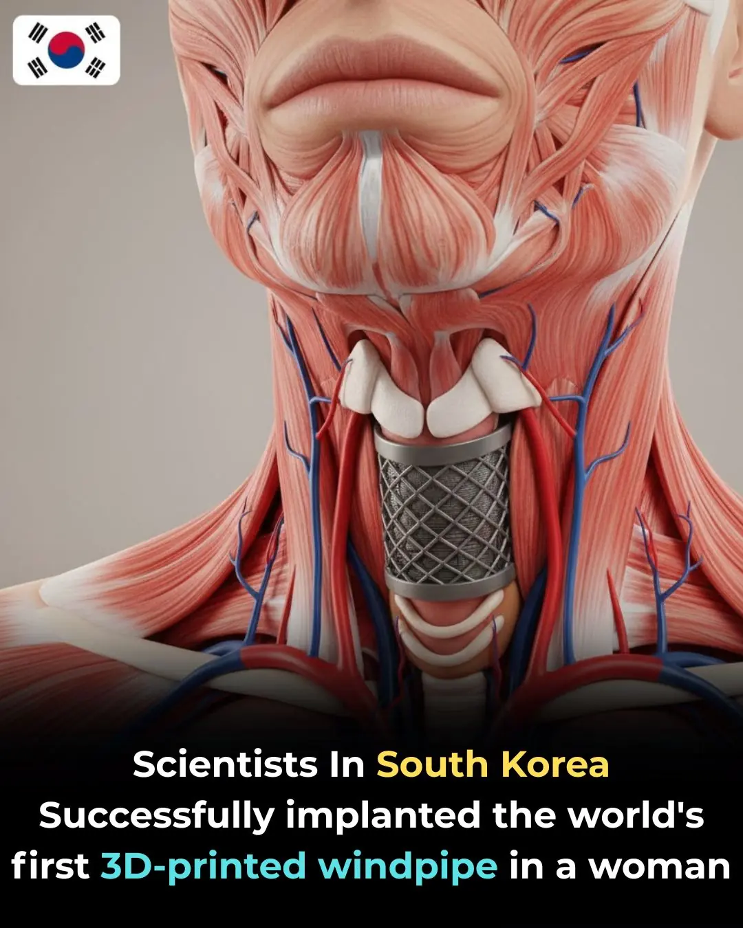 South Korean Scientists Successfully Implant the World’s First 3D-Printed Trachea — A New Era of Regenerative Medicine Begins