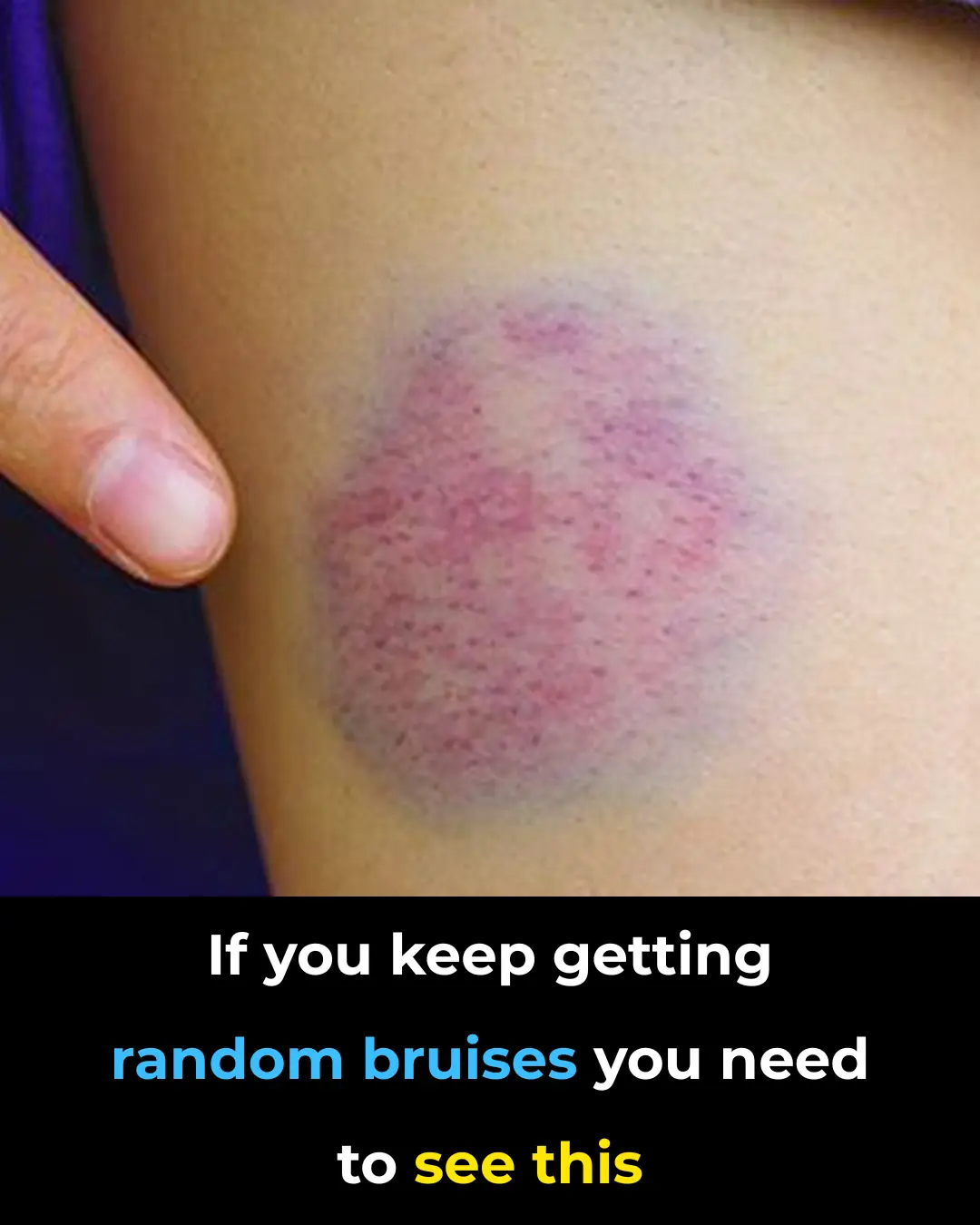 Unexplained Bruising on Your Body: Causes and Treatments