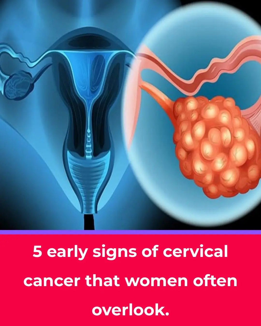 5 Early Signs of Cervical Cancer Most Women Ignore — Don’t Overlook Them!