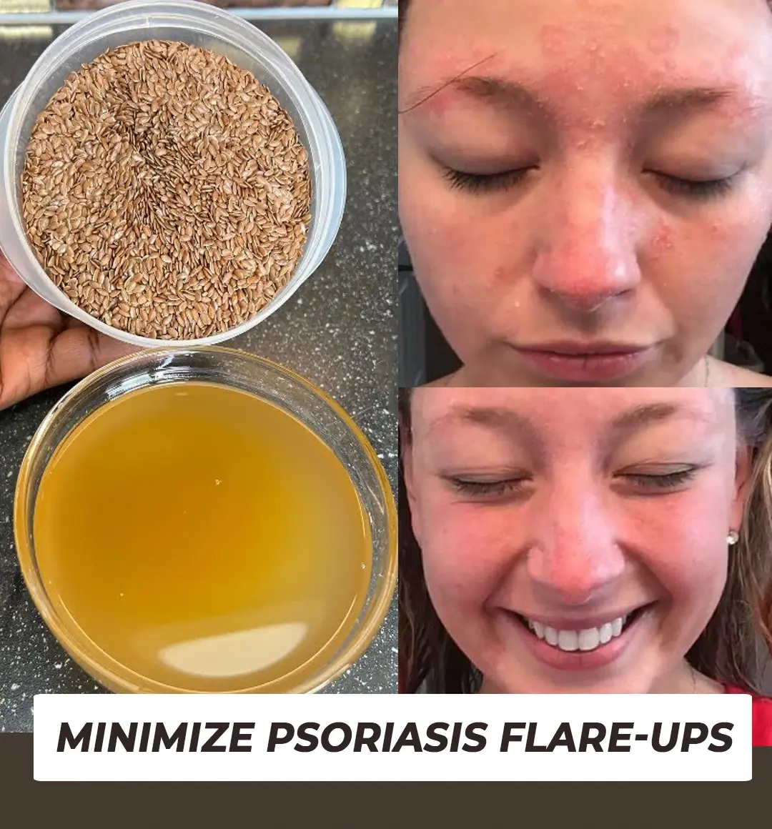 5 Ways to Prevent a Psoriasis Flare-up