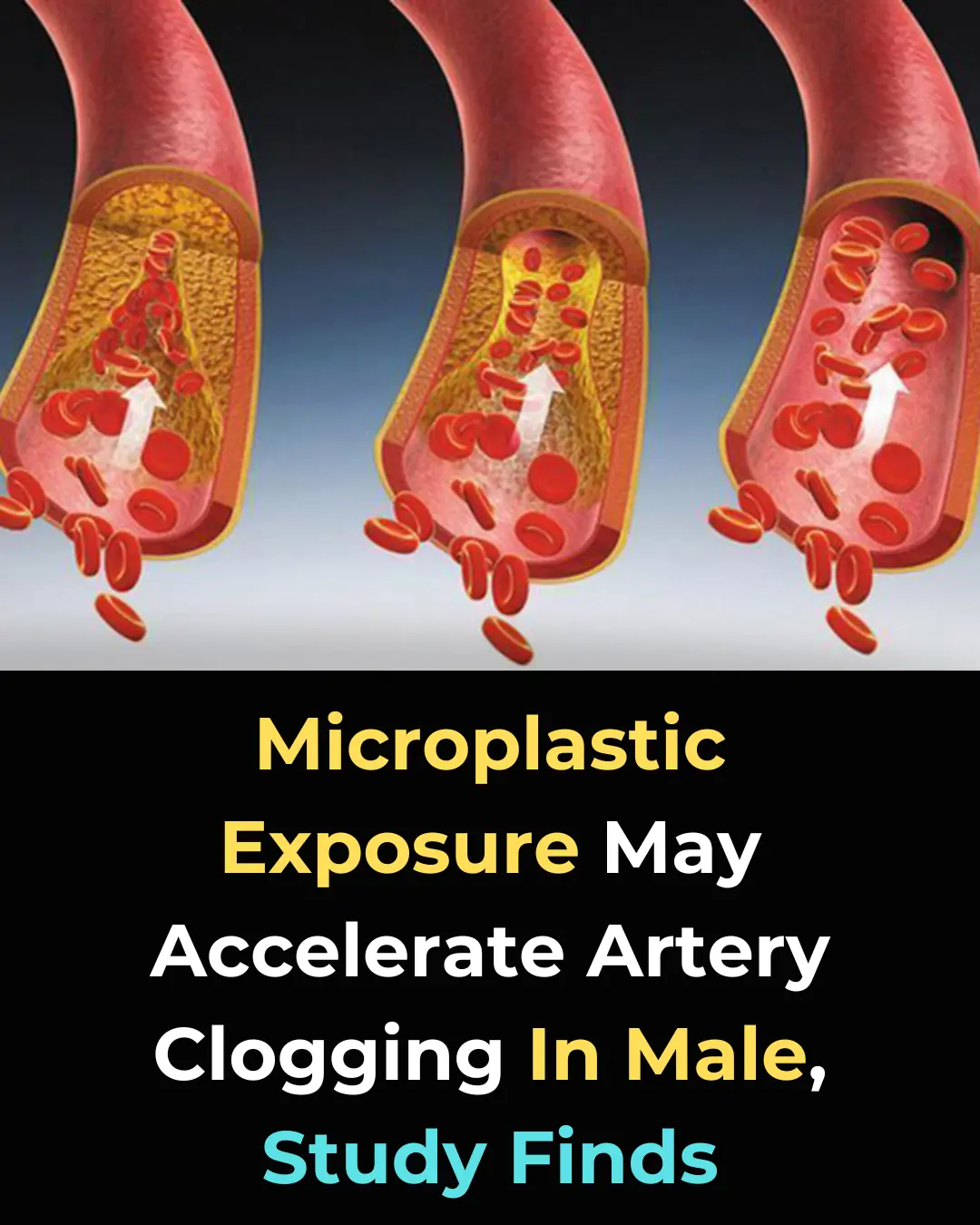 Microplastic Exposure Found to Worsen Artery Plaque Buildup in Male Mice, Study Reveals